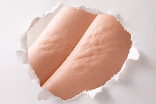 какво причинява целулит